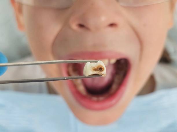 Best Knocked-Out Tooth (Avulsed Tooth) Treatment in Beaufort, NC